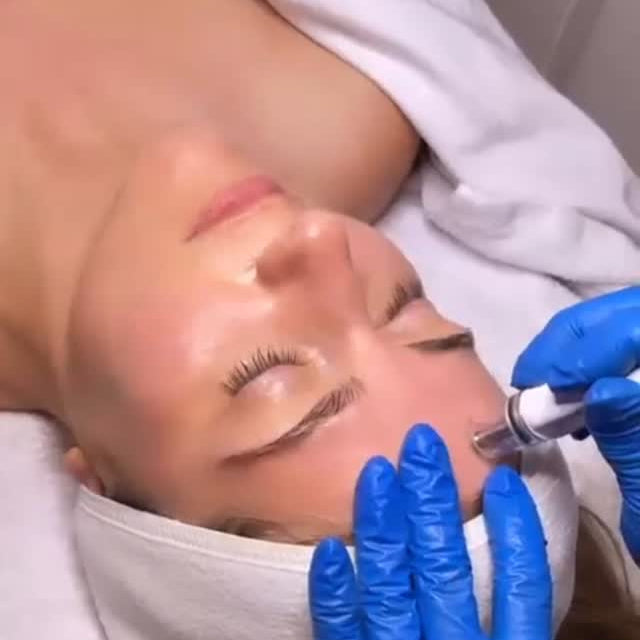 Radiofrequency Skin Tightening with Collagen Boost